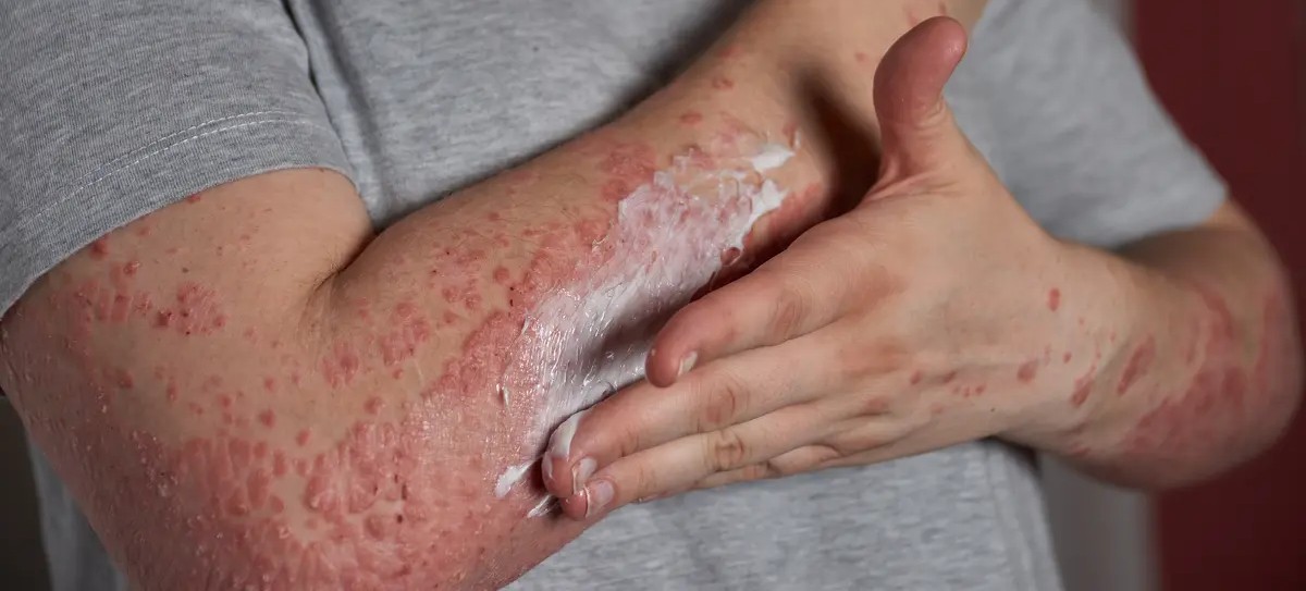 atopic dermatitis